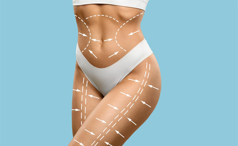 Body Contouring